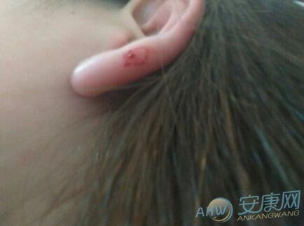 梦见被虫子咬出血的吉凶含义解读是什么意思